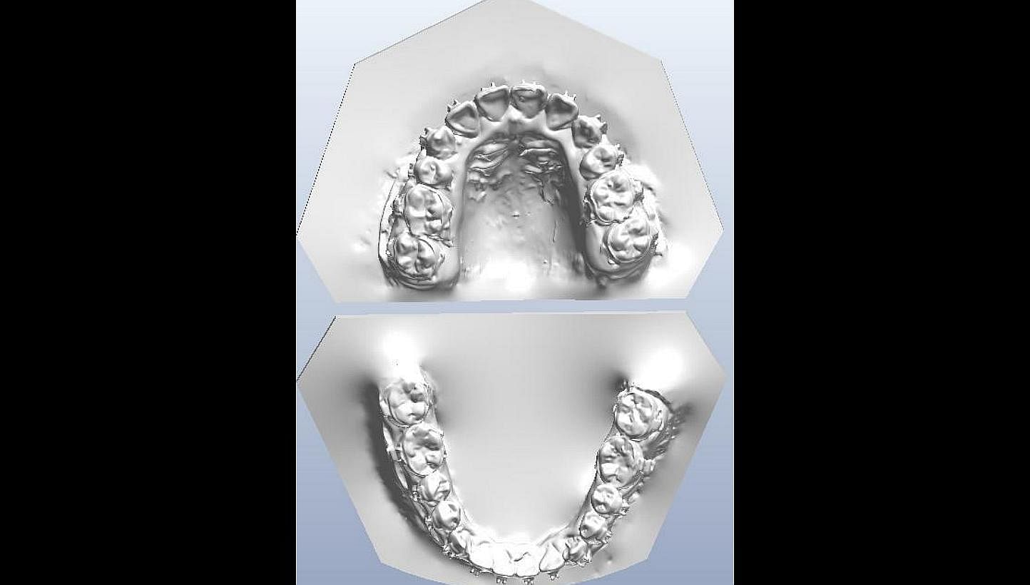 Samples of 3-D digital orthodontic models of patients' teeth that are now being used in place of plaster moulds at the National Dental Centre Singapore. -- PHOTO: NATIONAL DENTAL CENTRE SINGAPORE