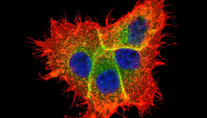 A file photo of a cancer cell.&nbsp;Cancer is often caused by the "bad luck" of random mutations that arise when cells divide, not family history or environmental causes, US researchers said Thursday. -- PHOTO: A*STAR