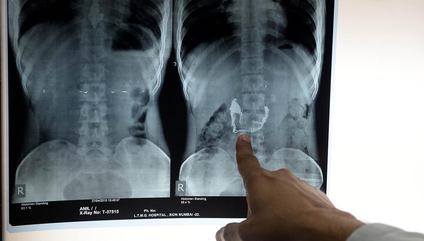 Lokmanya Tilak Medical College and Hospital dean&nbsp;Suleman Merchant pointing to an xray showing a necklace and pendant inside the stomach of alleged thief Anil Jhadav. Jhadav&nbsp;has been put on a special diet of bananas and special liquids by po