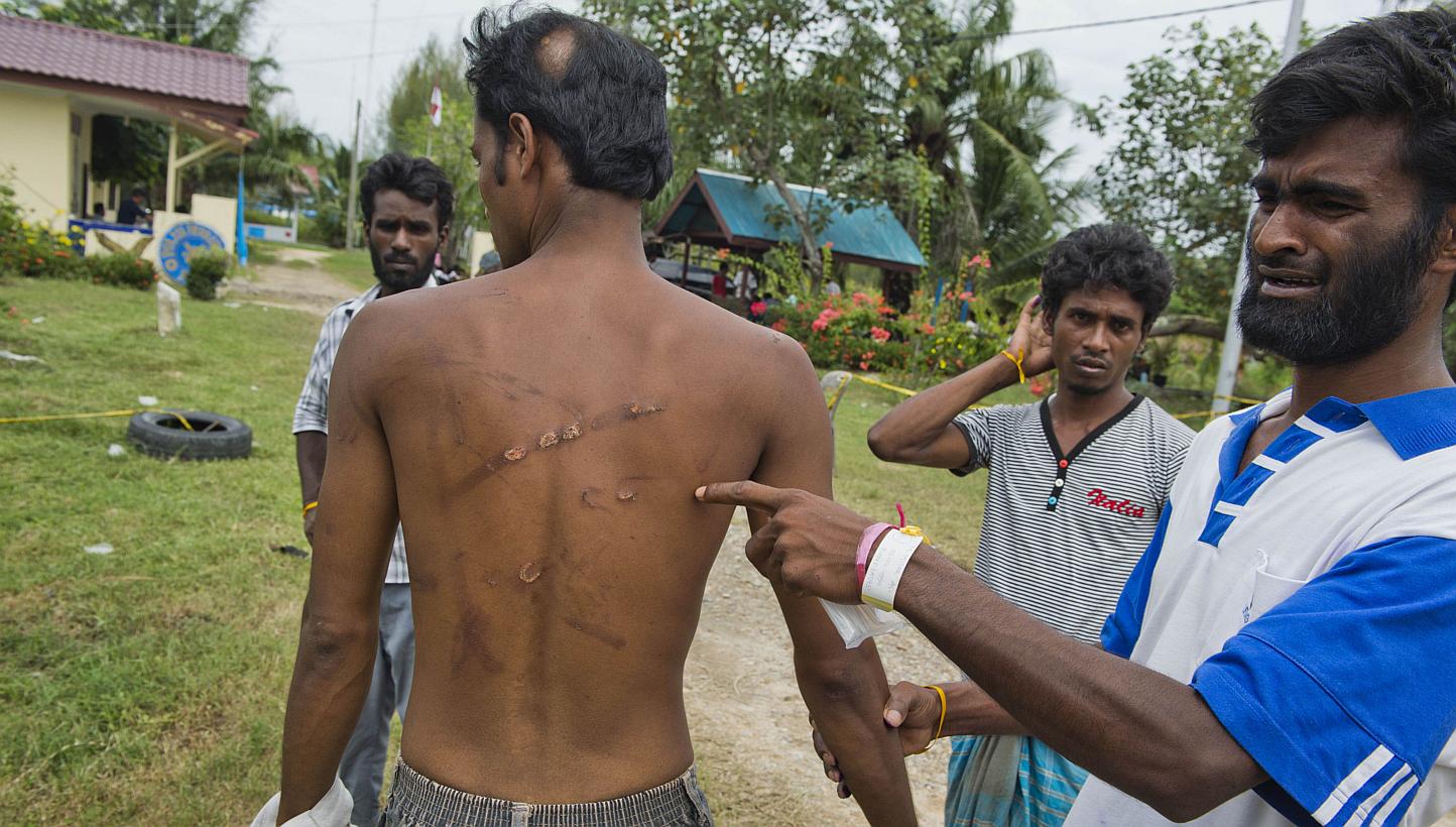 Bangladeshi Mohammad Meshar Ali showing compatriot Mohammad Murad Hussein's scars as he narrated the fight over supplies aboard the foundering boat off Indonesia.
