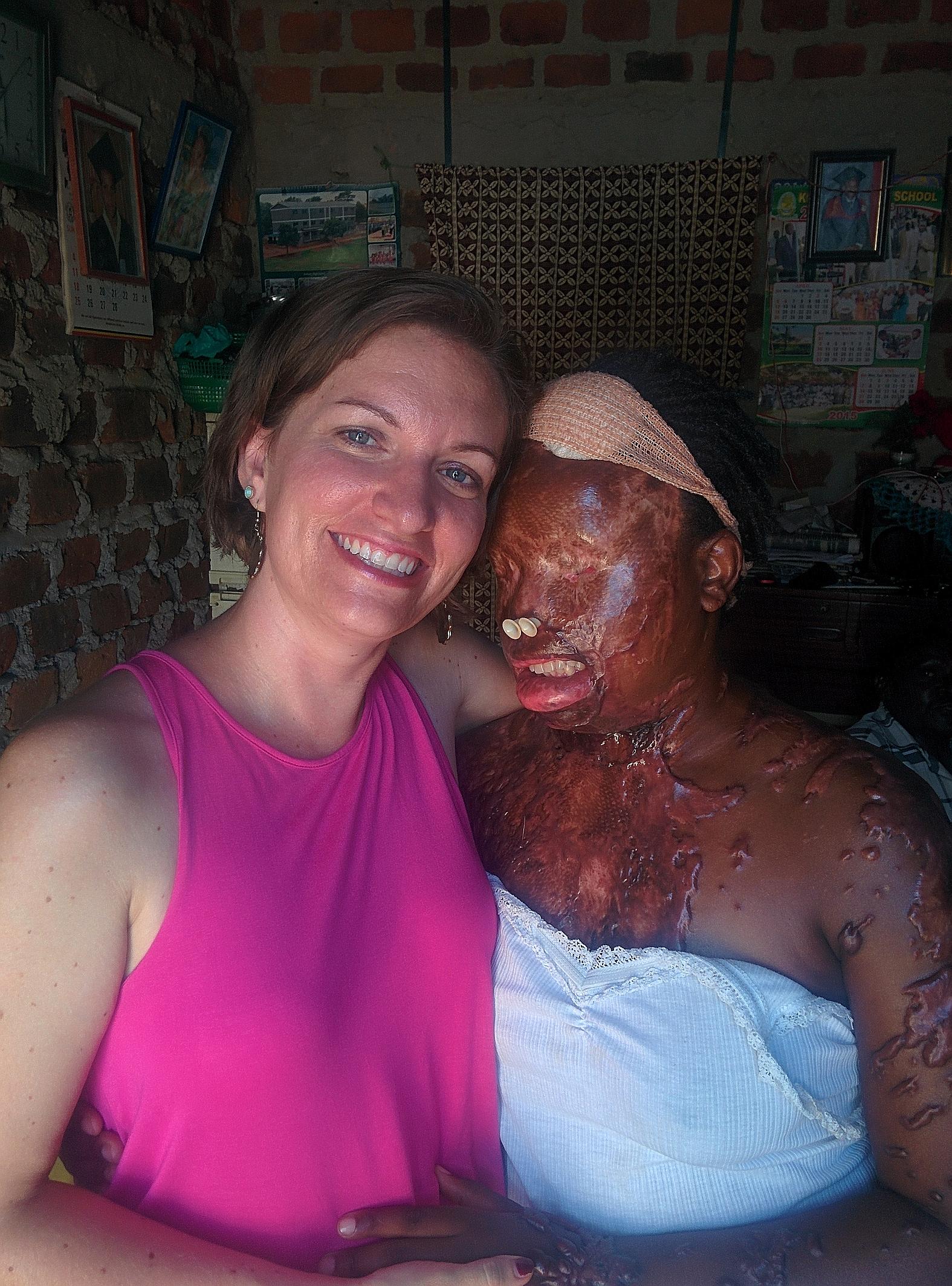 Acid attack victim Namale Allen with social activist Lynsay Lewis.