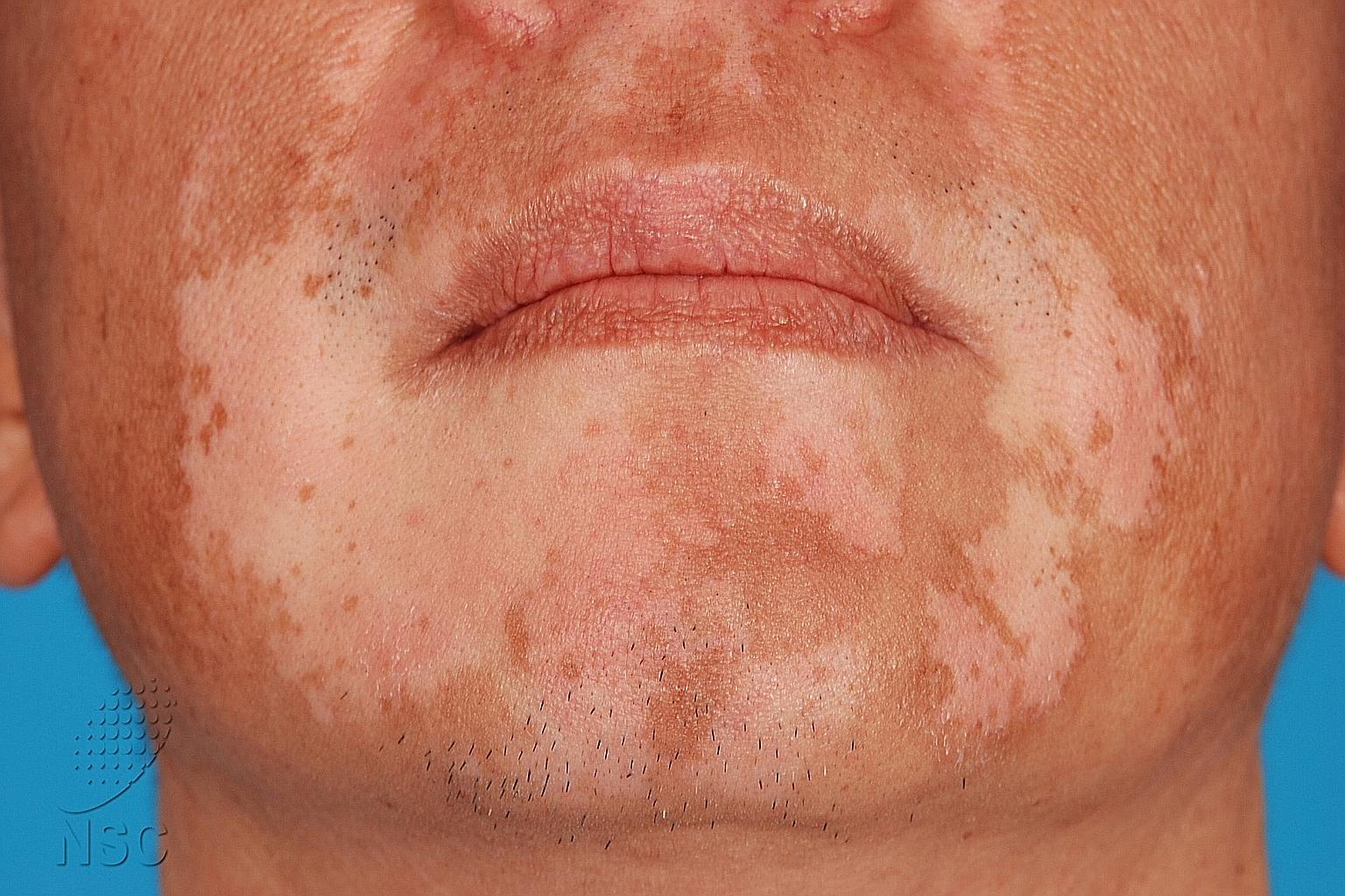 Vitiligo is a condition characterised by pale patches developing on a person's skin. It is not dangerous, but can cause patients to become self-conscious about their appearance.