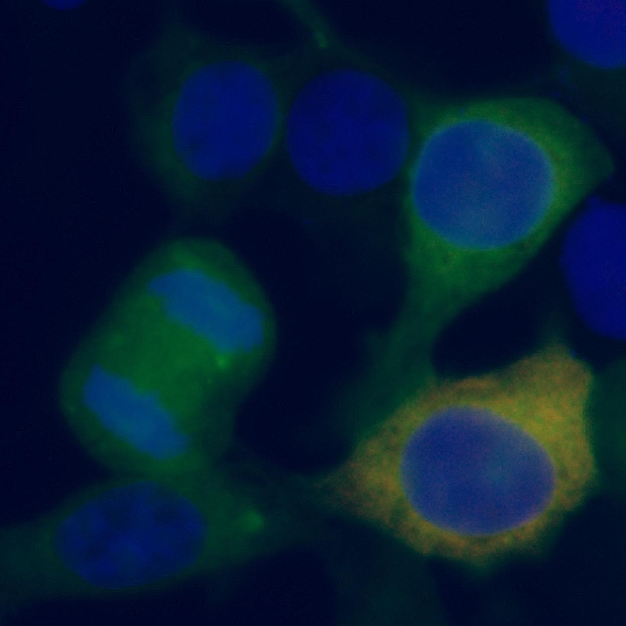 Mutant nucleophosmin proteins (green) are the culprits behind chromosomes that look normal in acute myeloid leukaemia cancer cells.