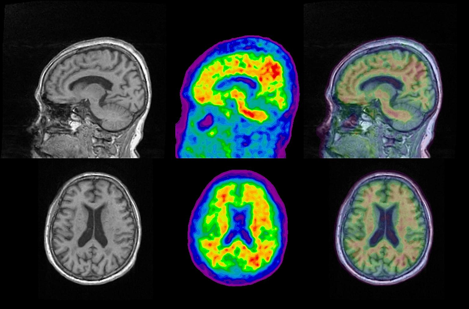 An MRI scan (far left) shows brain structure, while a PET scan (centre) lets researchers see amyloid presence in red. Combining the two images (left) could help doctors find out which parts of the brain have a build-up of the protein linked to Alzhei