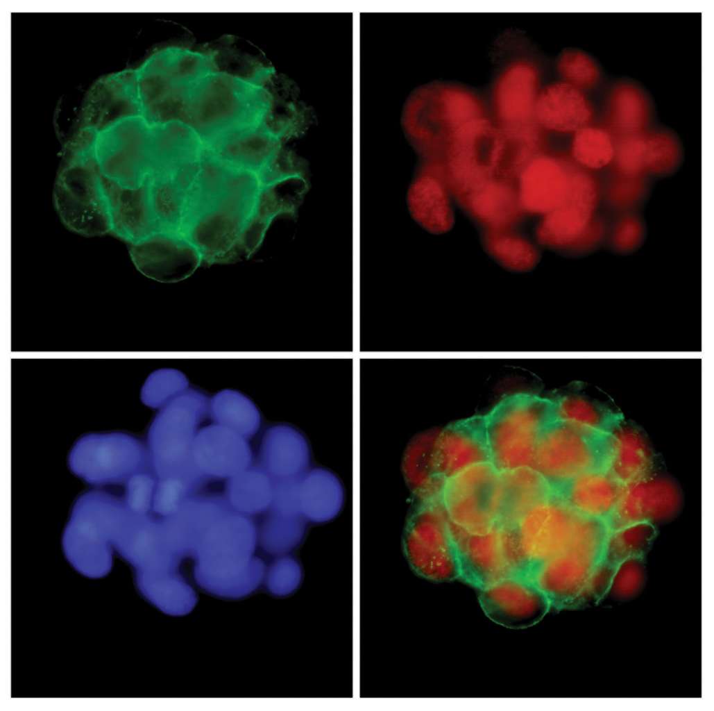 Scientists have found that gastric tumours (pictured) are not all the same. Individual gastric cancers can vary widely in aggressiveness and treatment response. 