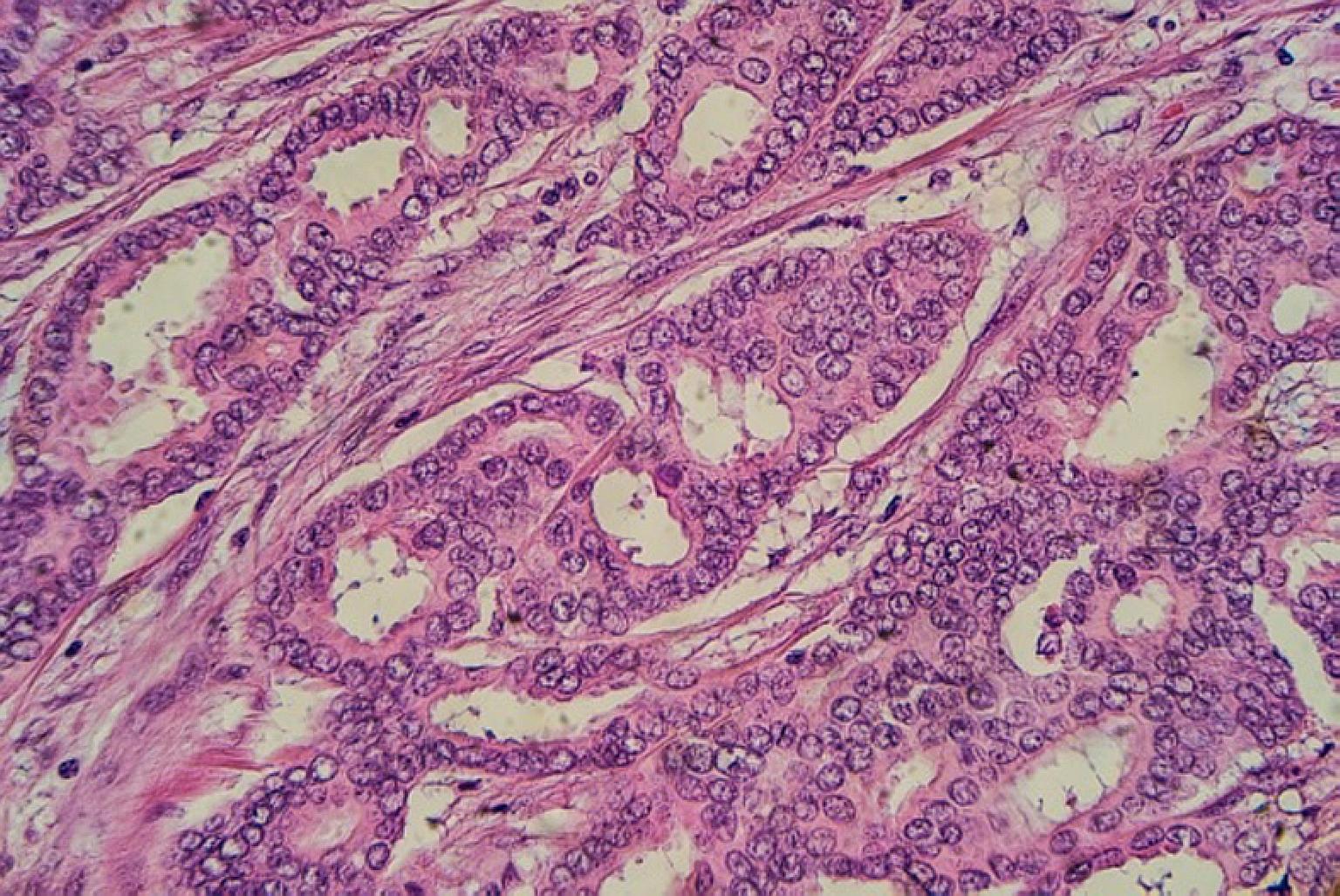 Left: Breast cancer cells. Around 1,900 women were diagnosed with breast cancer yearly from 2010 to 2014.