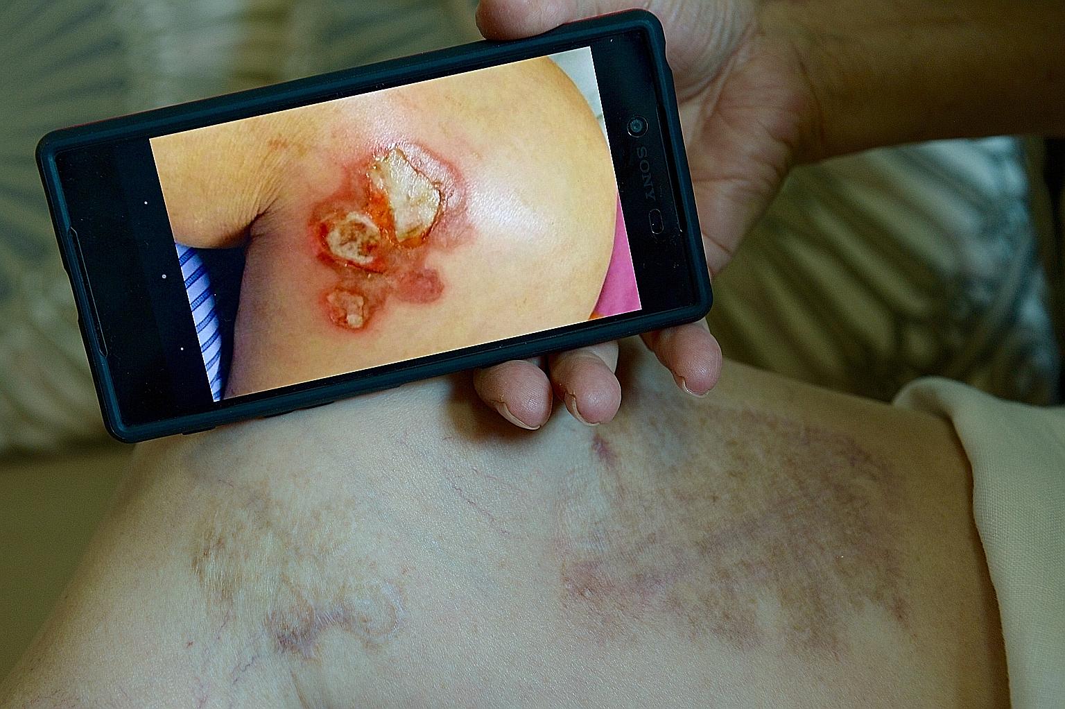 Madam Chow showing injuries on her right thigh (above) from the moxibustion treatment, and (left) a photo of a burn injury near her right knee.