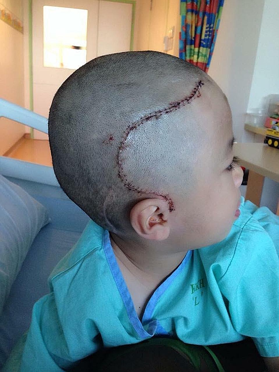 The scars on Javier Lim's skull are proof of the painful operations he has had over the past three years.