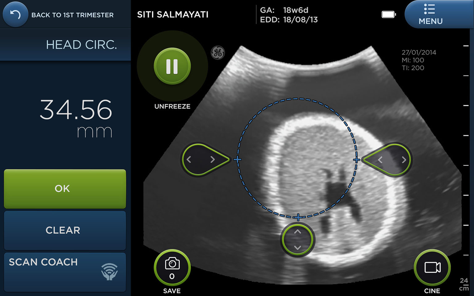 The user interface of the Vscan Access employs design elements that make it look friendly, yet professional, and also easy to use. Field studies have shown that the detection rates of potentially life-threatening conditions in pregnant women improved two-