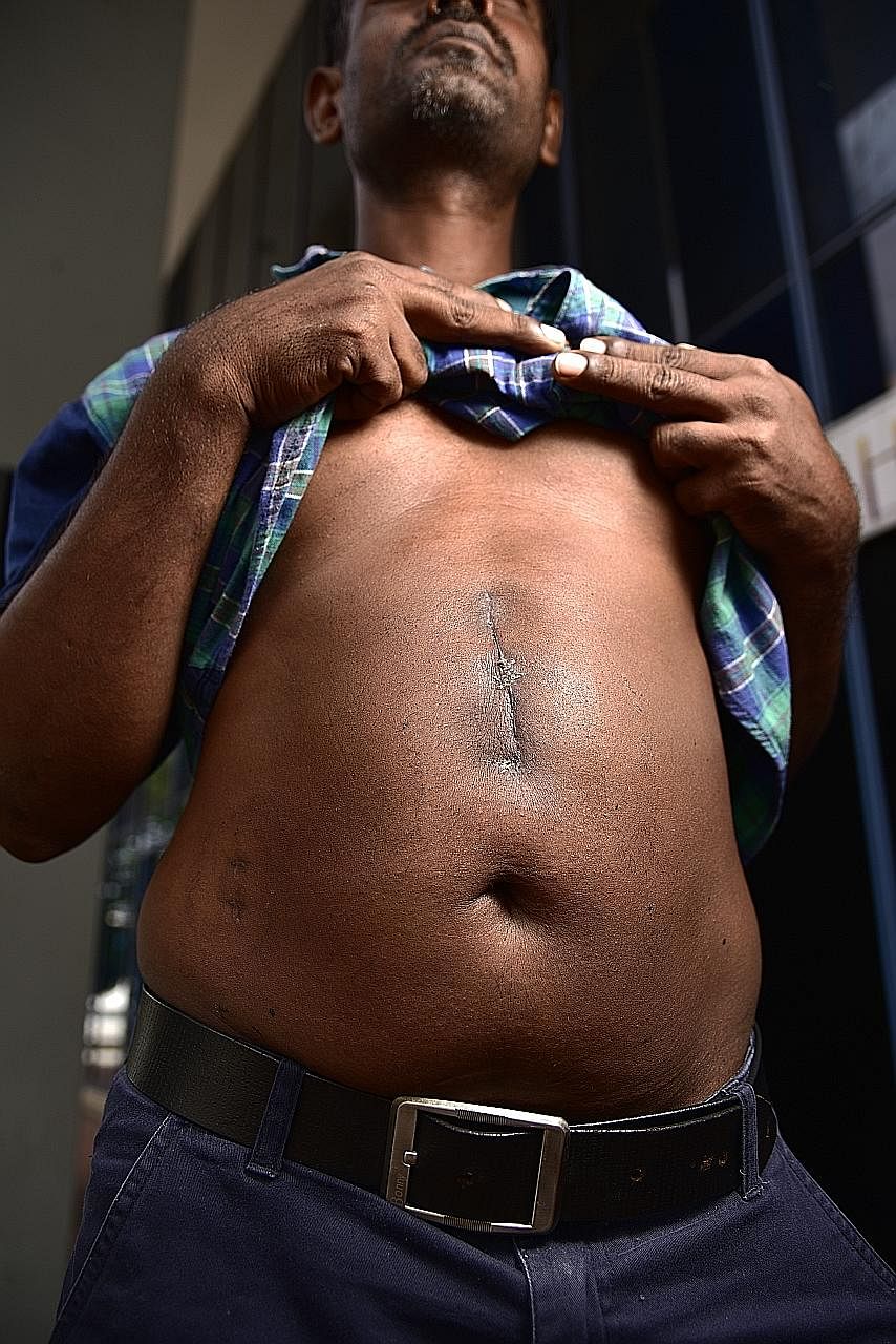 Welder S. Kumar showing the scar from surgery last month to treat a gastrointestinal perforation. His company wants to send him back to India to recuperate.