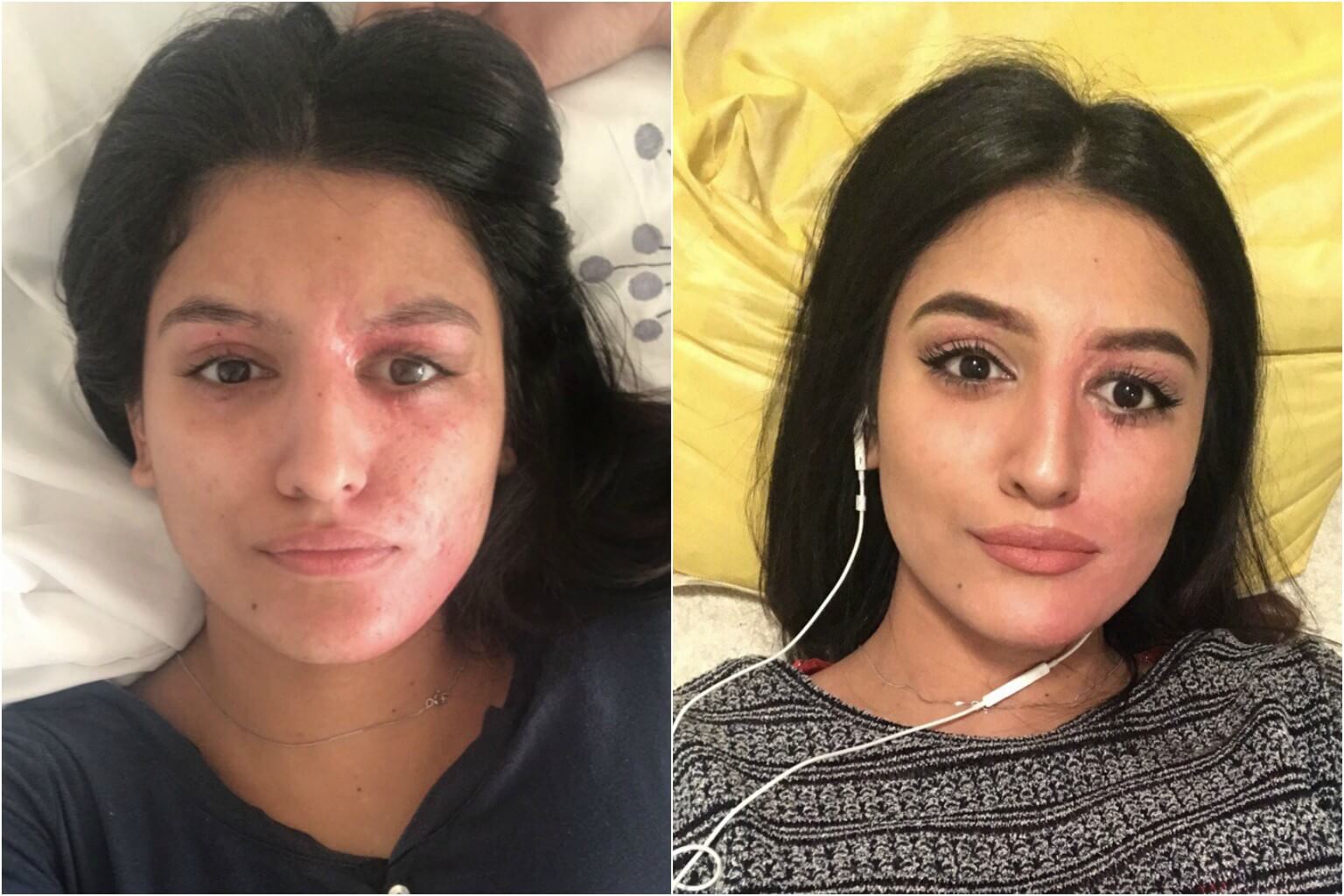 Acid attack victim blogs about truth of make-up and beauty routine ...