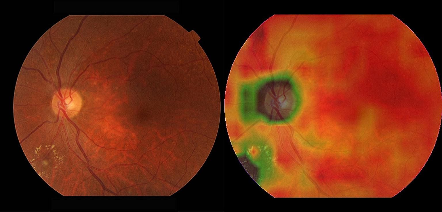 (Far left) A retinal image with diabetic retinopathy (DR) next to a heat map generated by the AI system which highlights where the DR lesions are.