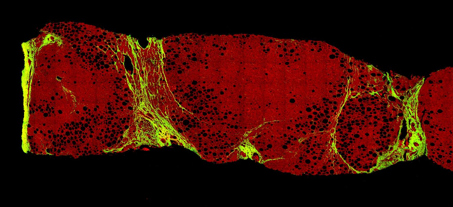 An image taken by Laennec of liver tissue with non-alcoholic steatohepatitis. The imaging technology highlights fine collagen fibres, which cannot be observed using conventional staining techniques.