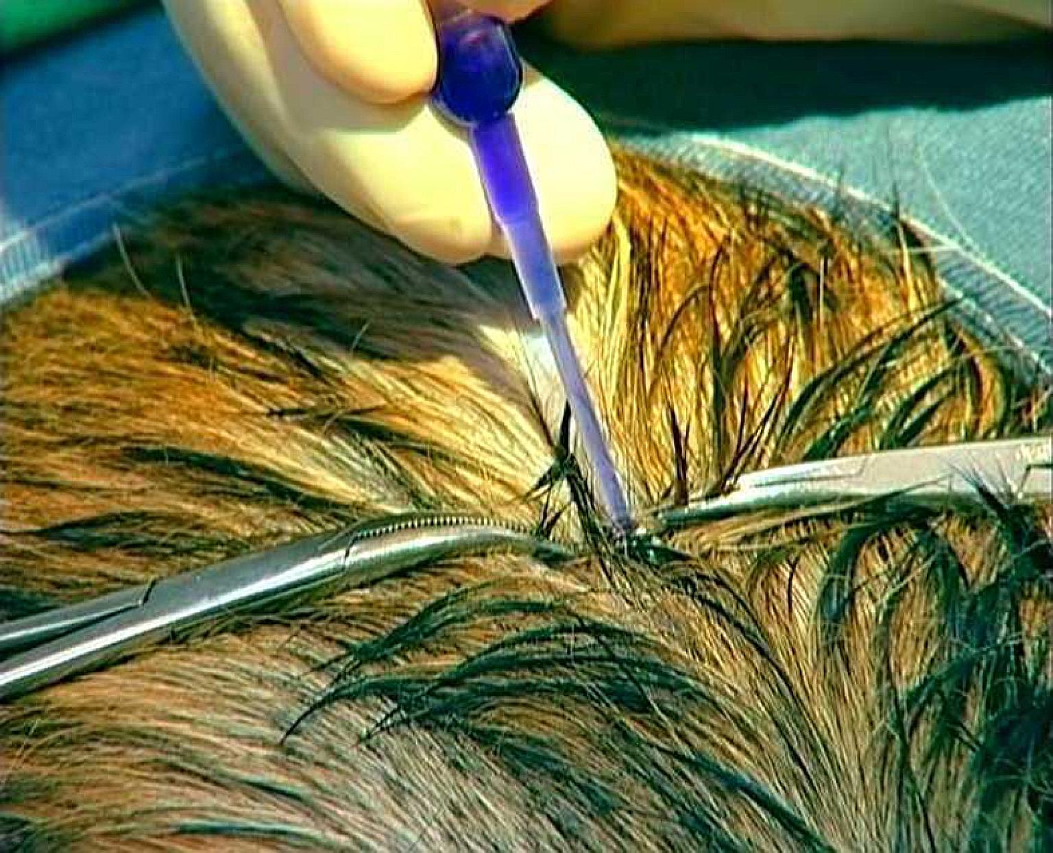 Associate Professor Marcus Ong's method uses hair and tissue glue to seal a head wound, thus avoiding the need for stitching and shaving.