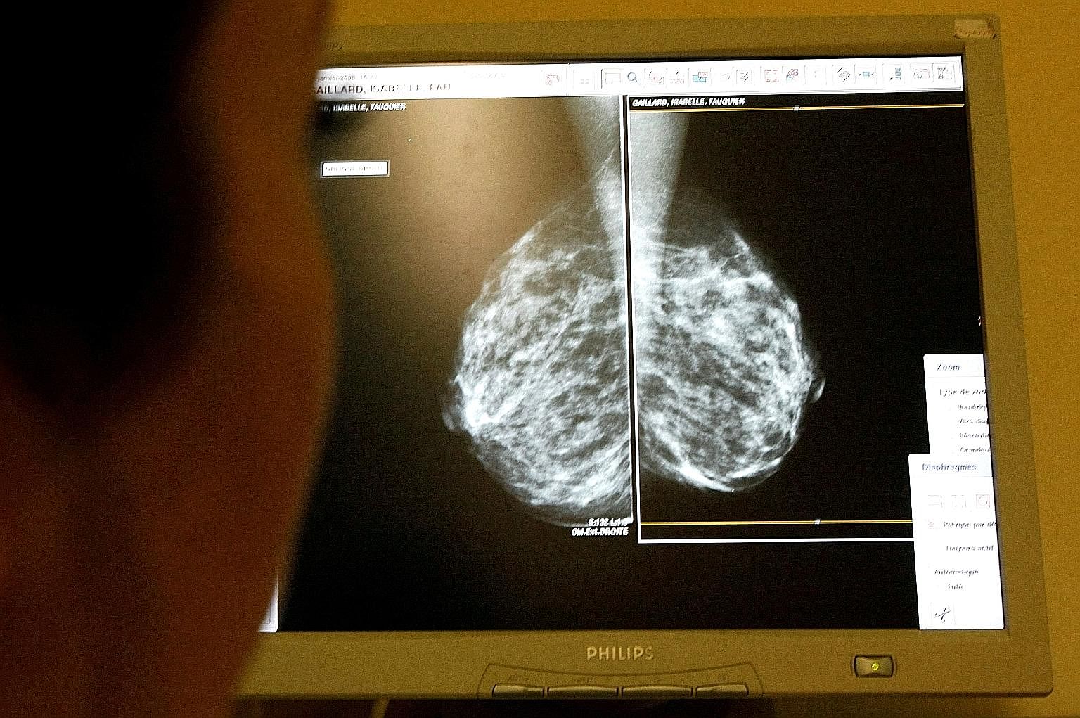 A doctor in France examining a mammogram. The TAILORx results will help provide more individualised breast cancer care, says Tan Tock Seng Hospital's Dr Juliana Chen.