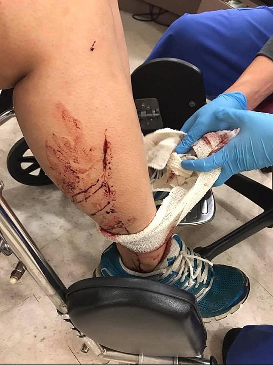 Ms Jenn Low's sister suffered cuts on her right temple, arm and leg after she was knocked down by an e-scooter rider in Bukit Panjang on Tuesday. Ms Low said the rider did not stop or provide help, but fled the scene instead.