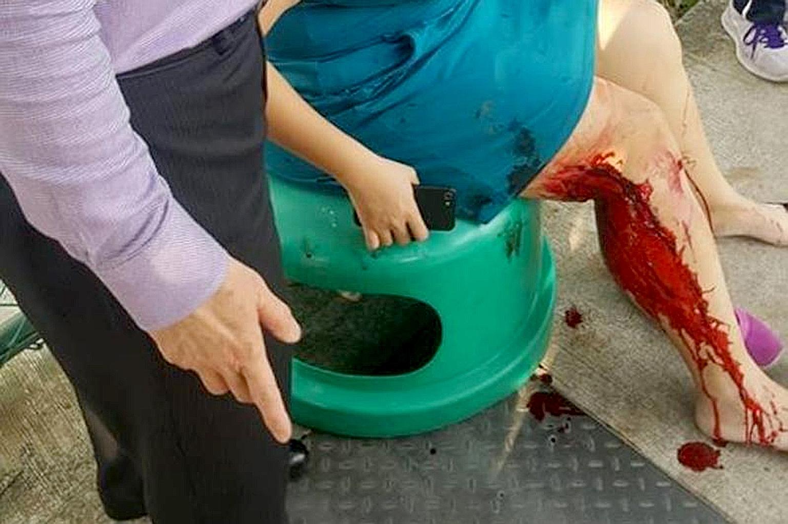 The victim, identified as Ms Alice Ng, suffered vicious bite marks and lacerations on her back, arms and legs in the wild boar attack.