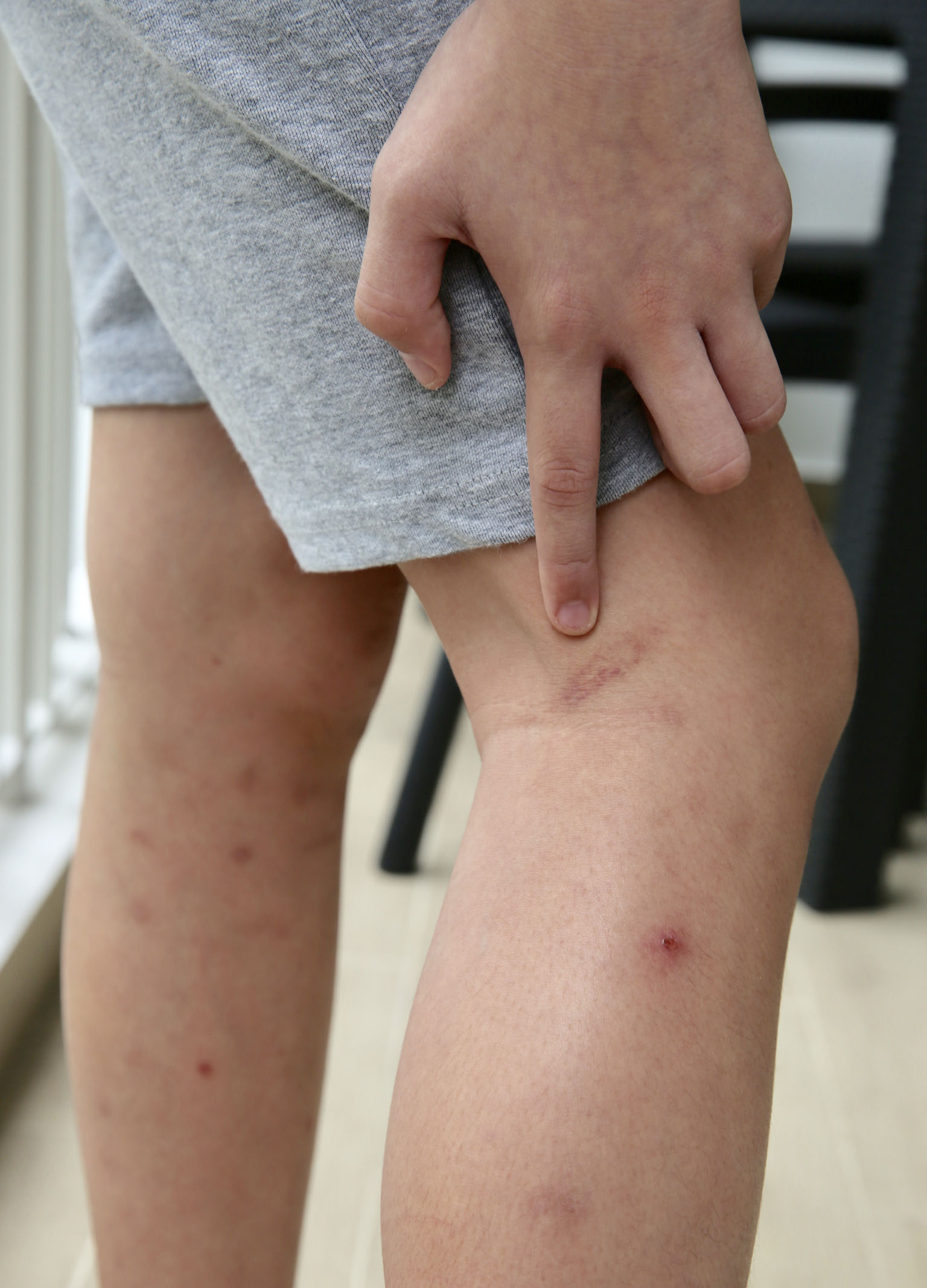 Ms Claire Kang, the pupil's mother, discovered cane marks on her son's arms and legs. She says that the school's discipline headmistress caned her son and a classmate without informing the boys' parents.