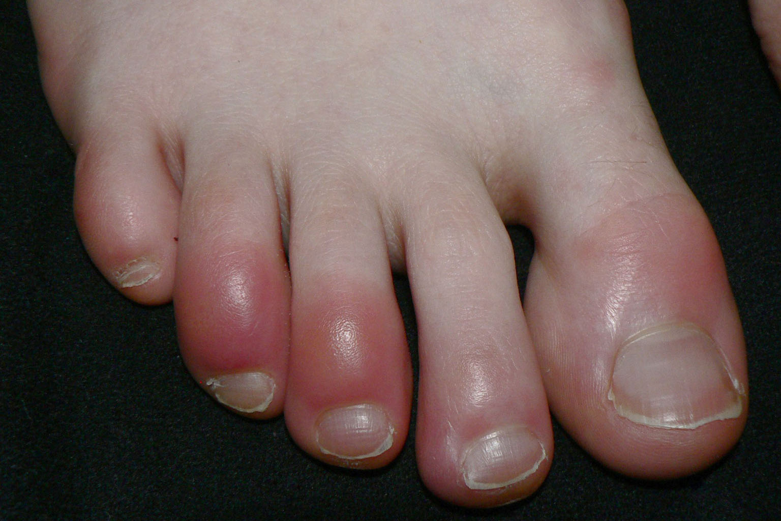 There could be something about the virus itself that is causing coagulation, which has some precedent in other viral illnesses. PHOTO: WIKIMEDIA COMMONS