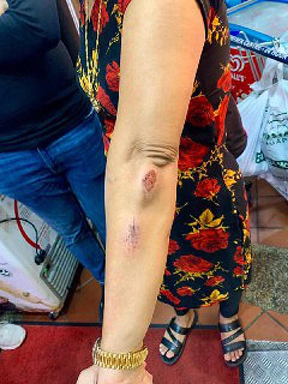 Madam Hindocha Nita Vishnubhai, 55, said she was brisk walking from Choa Chu Kang MRT station towards the stadium at about 8.30am last Friday when the alleged attack occurred near Northvale Condominium (top). She has scratches (above) on her arms and