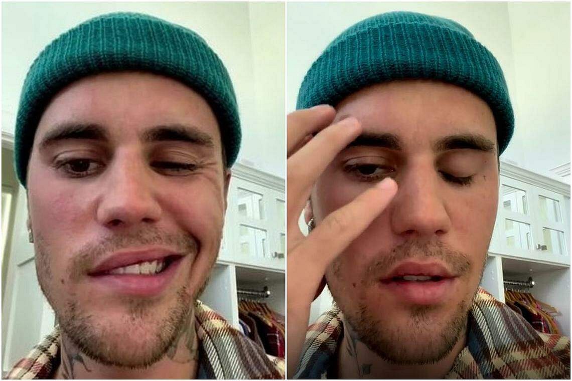 Justin Bieber Shows His Recovery From Partial Facial Paralysis In ...