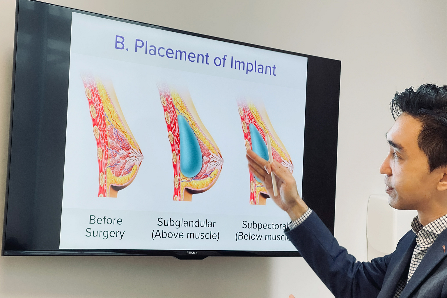 Implants fat grafting and recovery What to know before getting a