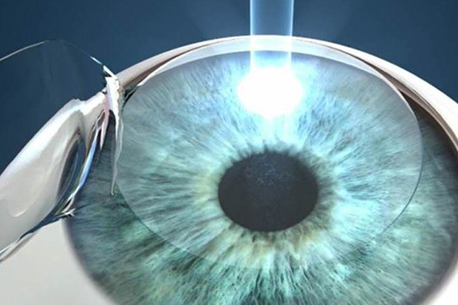 To undergo Lasik surgery, a person must have a normal cornea with no cornea disease and sufficient cornea thickness. The procedure aims to correct refractive error - myopia, hyperopia and astigmatism.