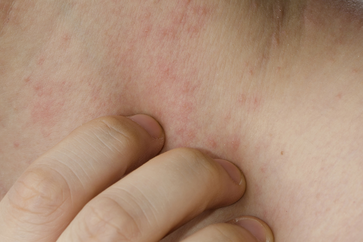Consult a doctor if you have tried self-medication on a skin rash without success.