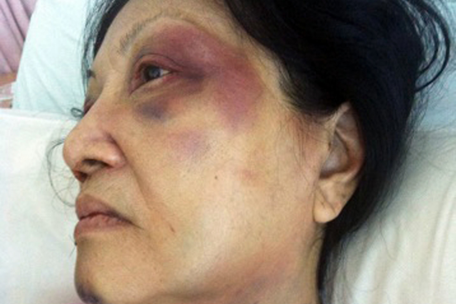 Madam Toh in hospital after being attacked by her neighbour outside her flat in 2013. Haunted by memories of the attack, she cannot fall asleep sometimes, and used to wake up in the middle of the night screaming.