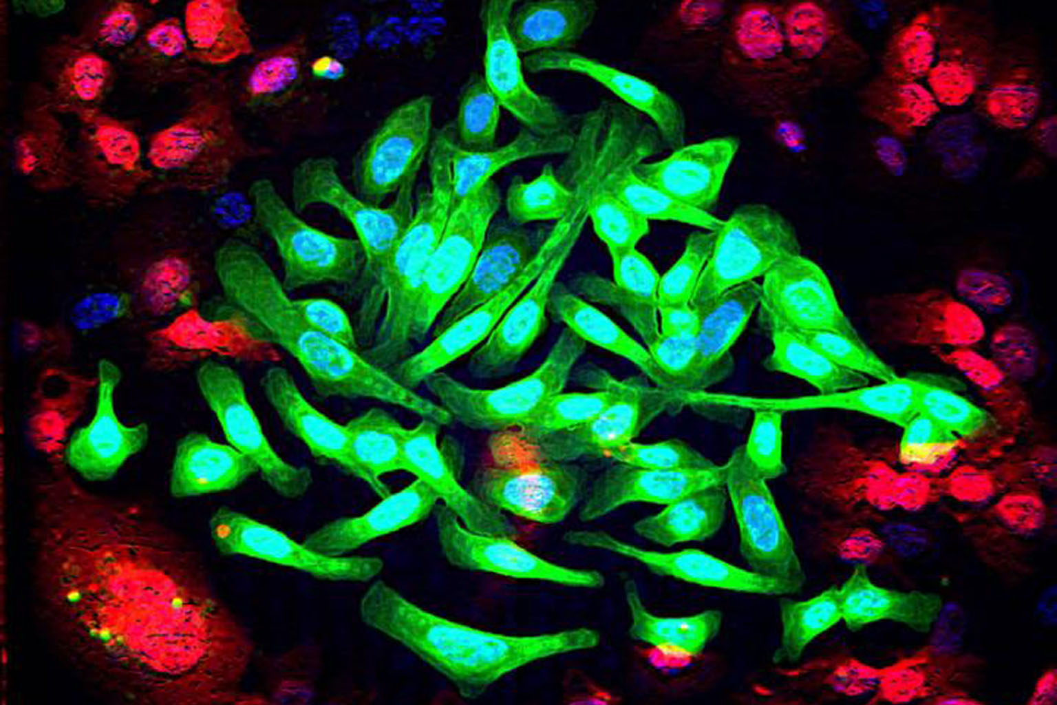 Lung cancer cells (green) cultured with normal lung cells (red). Research on lung cancer should no longer just be about finding specific gene mutations, or drugs that can block them, says Associate Professor Tan Eng Huat from NCCS.