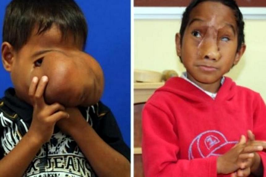 This combo of undated handout photos released on July 3, 2014 by the Monash Children's Hospital in Melbourne shows seven-year-old Jhonny Lameon from the Philippines before (L) and after (R) having surgery to remove a huge tumour from his face. - AFP