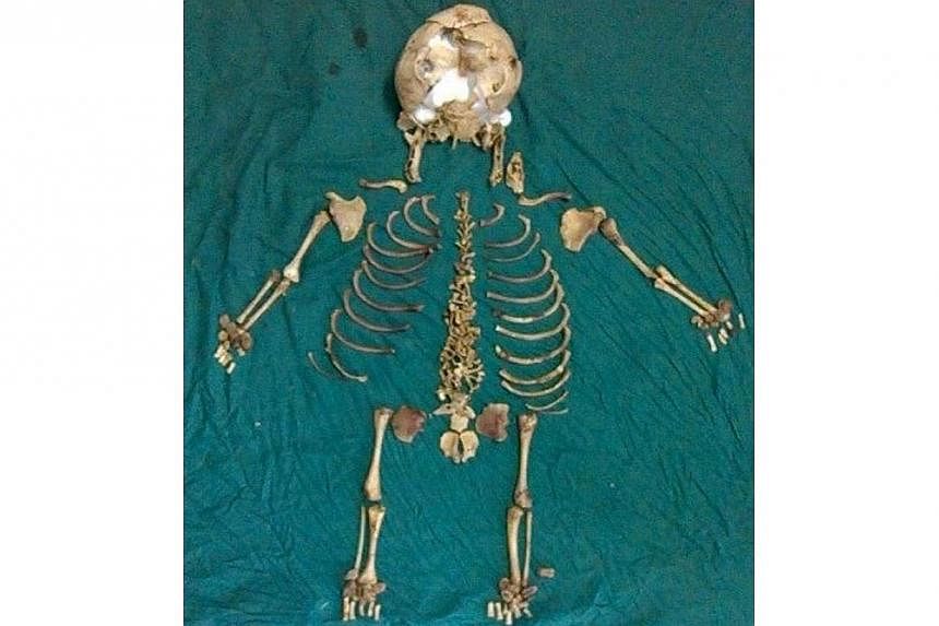 This handout photograph from the Department of Surgery of the N K P Salve Institute of Medical Sciences in Nagpur on August 25, 2014 shows the re-arranged skeleton of a foetus believed to have been inside a woman for 36 years.&nbsp;-- PHOTO: AFP