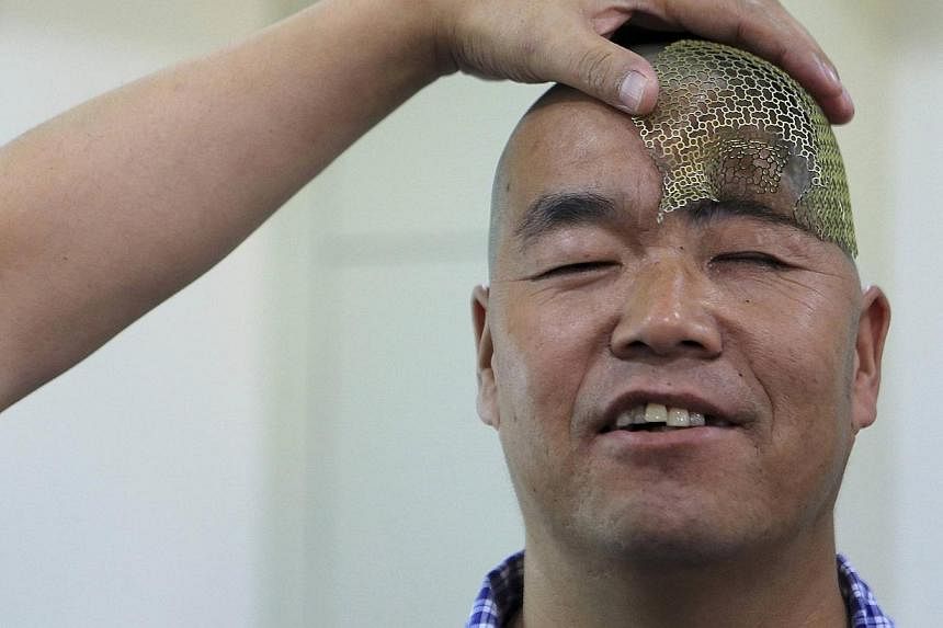 A medical staff displays a titanium mesh produced by a 3D printer before surgery to place it in the head of a patient surnamed Hu, at a hospital in Xi'an, Shaanxi province, on Aug 27, 2014. -- PHOTO: REUTERS