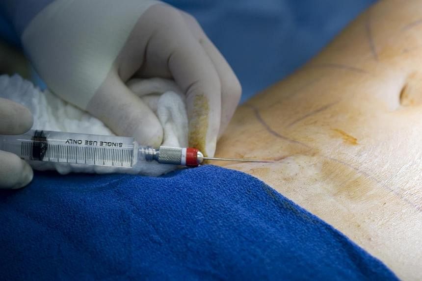 The Ministry of Health has revised licensing conditions for liposuction to further enhance the safety of the procedure. -- PHOTO: ISTOCK