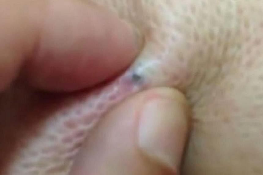 Chinese man returns from Africa trip to discover 20 live maggots living  under his skin