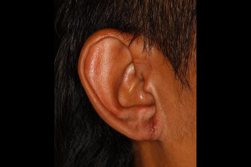 Reconstruction of a gauged ear lobe involves using the patient's own tissue and can cost around $3,000 for both sides.
