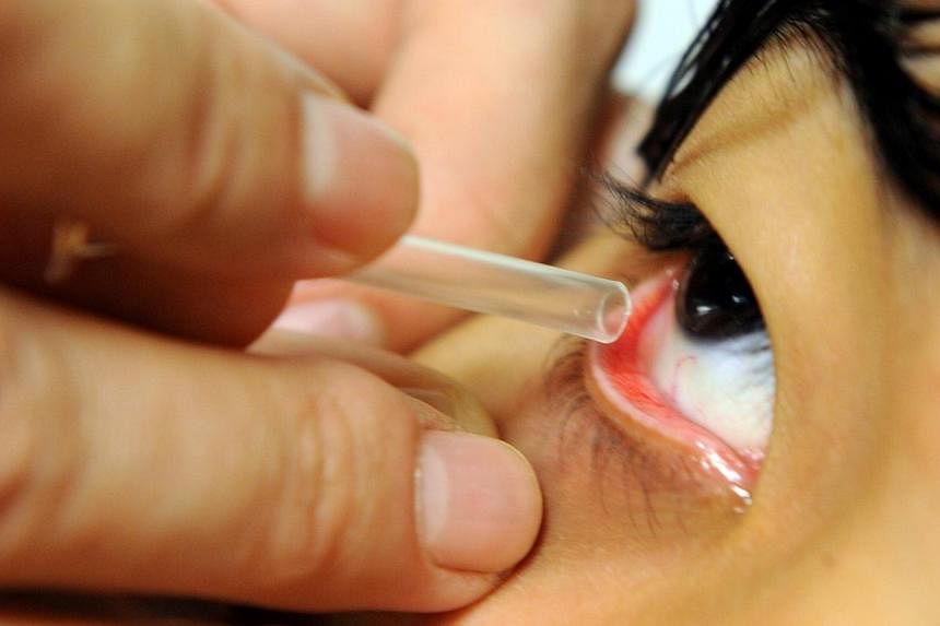 Western and TCM doctors will look into how effective TCM treatments are when it comes to dry eyes in a new study funded by the Ministry of Health. -- PHOTO: ST FILE