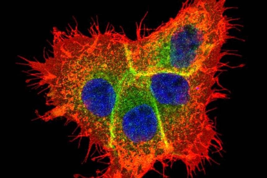 A file photo of a cancer cell.&nbsp;Cancer is often caused by the "bad luck" of random mutations that arise when cells divide, not family history or environmental causes, US researchers said Thursday. -- PHOTO: A*STAR