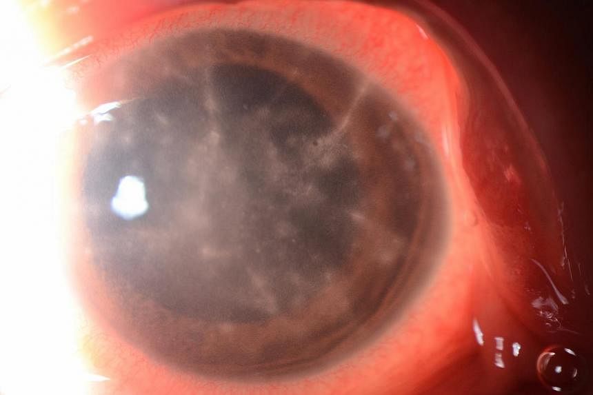 Pictures showing a healthy eye (right) as well as an infected one (below). In 2013, the public sector alone treated a total of 531 corneal infections, of which 362 were contact lens related. Coloured lenses accounted for 92 of the infections.