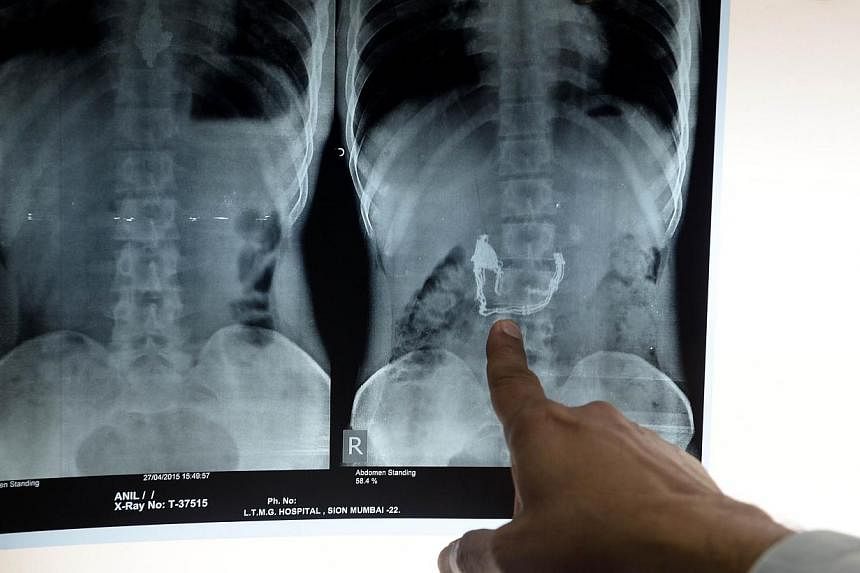 Lokmanya Tilak Medical College and Hospital dean&nbsp;Suleman Merchant pointing to an xray showing a necklace and pendant inside the stomach of alleged thief Anil Jhadav. Jhadav&nbsp;has been put on a special diet of bananas and special liquids by po