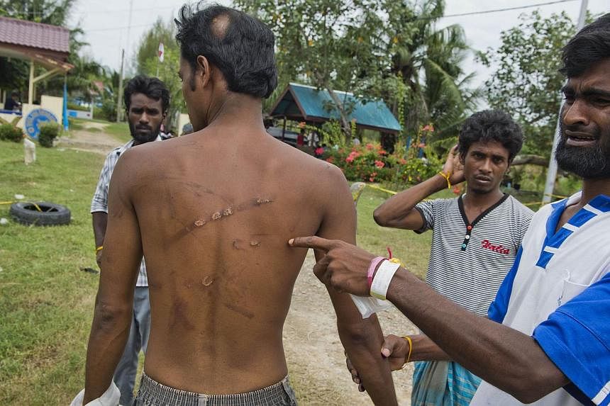 Bangladeshi Mohammad Meshar Ali showing compatriot Mohammad Murad Hussein's scars as he narrated the fight over supplies aboard the foundering boat off Indonesia.
