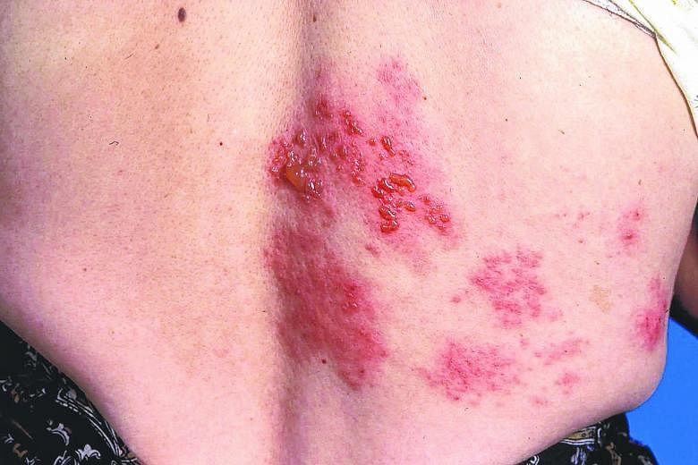 Shingles (above) is a painful condition caused by the varicella zoster virus which also causes chicken pox. The risk and severity of shingles increase with age as the immune system weakens.