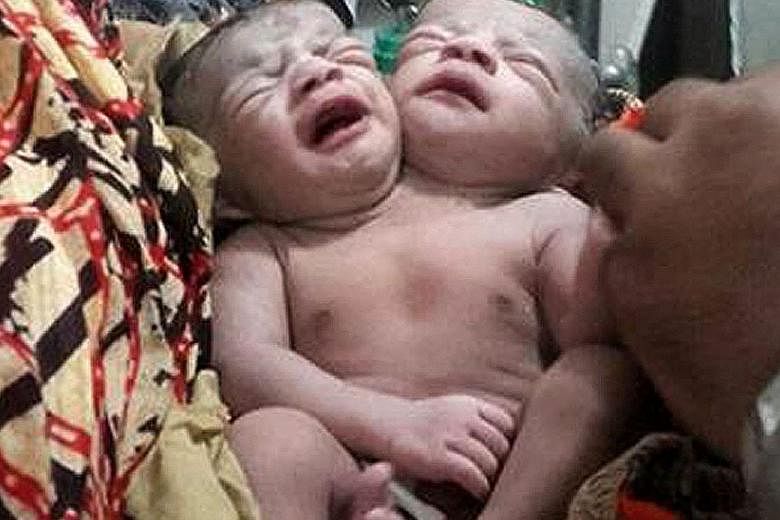 A woman gave birth to a baby girl with two heads via caesarean section on Wednesday, medical officials in Bangladesh said. The infant is now being treated for breathing difficulties in the Standard Hospital of Total Healthcare in Dhaka. "When I saw m