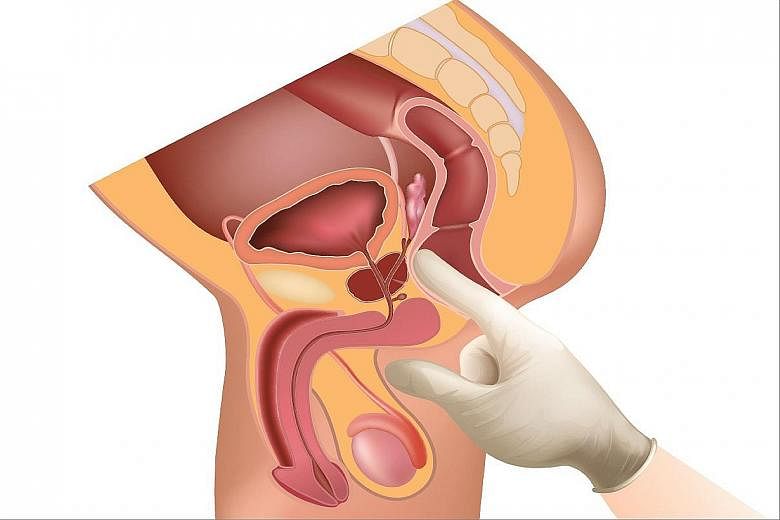 A digital rectal examination involves inserting a gloved, lubricated finger into the rectum to feel the back of the prostate gland and check for abnormalities.