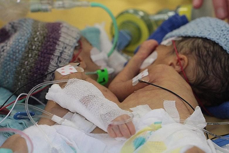 Conjoined twins Lydia (left) and Maya before their operation in Switzerland last December. They were eight days old when doctors separated them. The girls, who have a triplet sister, weighed a total of 2.2kg at the time of their operation.