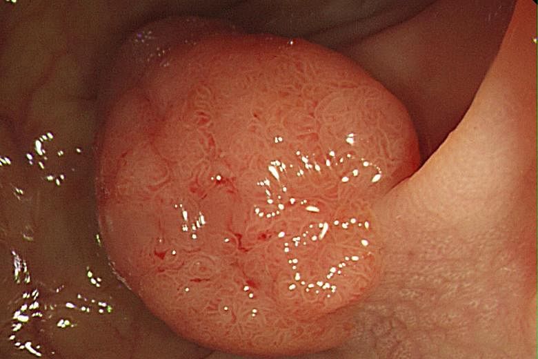 A common polyp (above) "stands up"; the "flat" polyp is nearly 10 times more likely to be cancerous.