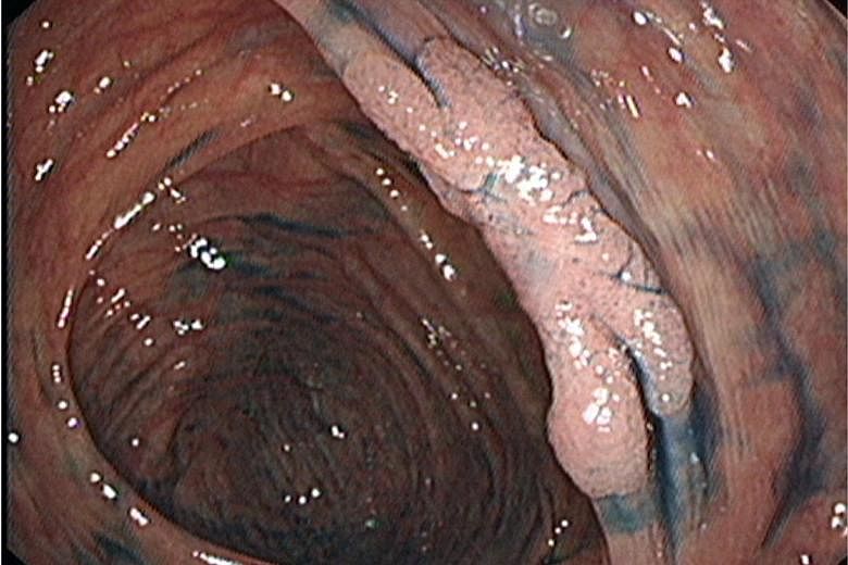 A common polyp "stands up"; the "flat" polyp (above) is nearly 10 times more likely to be cancerous.
