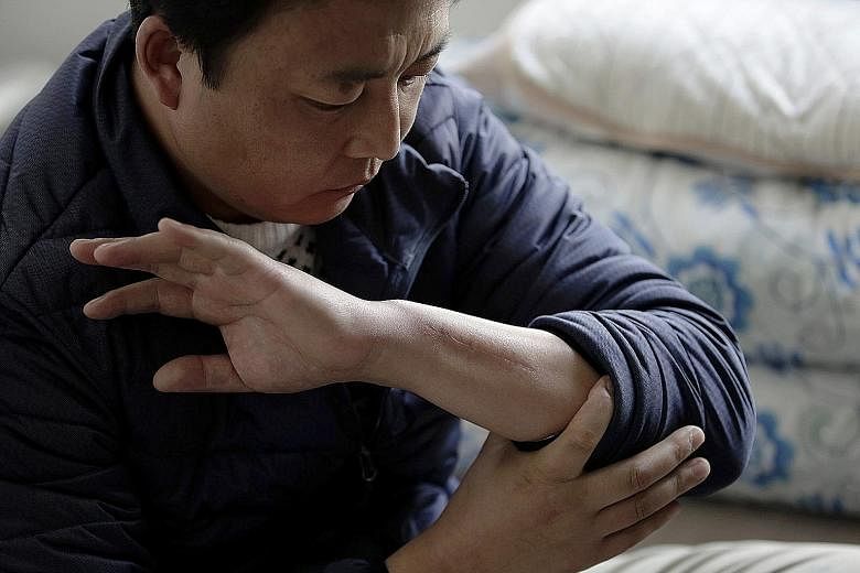 Chinese "trainee" Zhang Wenkun showing a scar on his arm from an injury at a waste recycling firm. He received insurance payments while he was off work for three months, but when he returned to work and his hand began to hurt again, the company threw