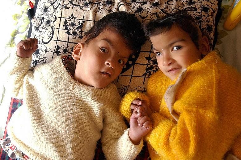 Nepalese conjoined twins Ganga (left) and Jamuna were separated in 2001. Jamuna is the only surviving twin and still requires medical treatment.
