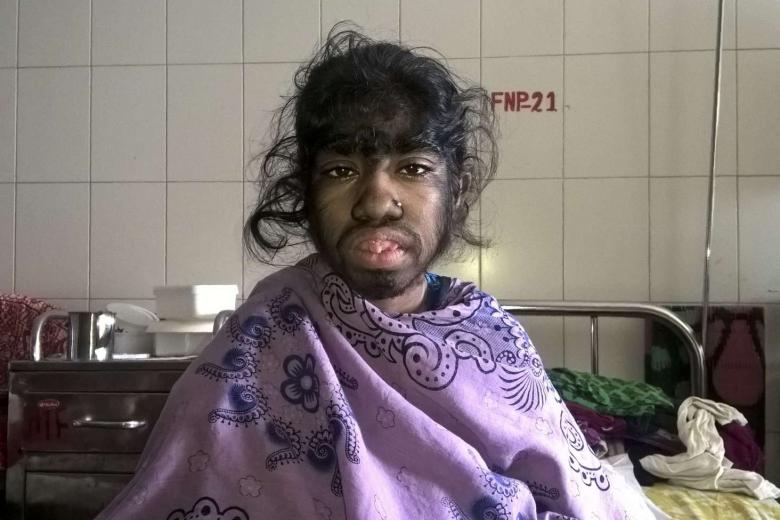 Bangladeshi girl, 12, seeks help for rare 'werewolf syndrome' as thick